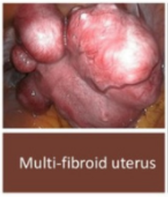 Photo of multiple fibroids in uterus