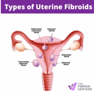 Types of Fibroids