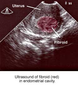 Ultrasound photo of fibroids in the uterus