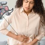 Women experiencing fibroid sloughing