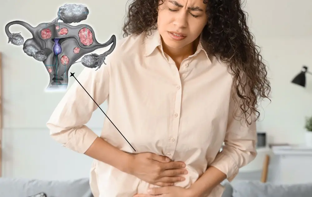 What Is Fibroid Sloughing? 19 Women experiencing fibroid sloughing
