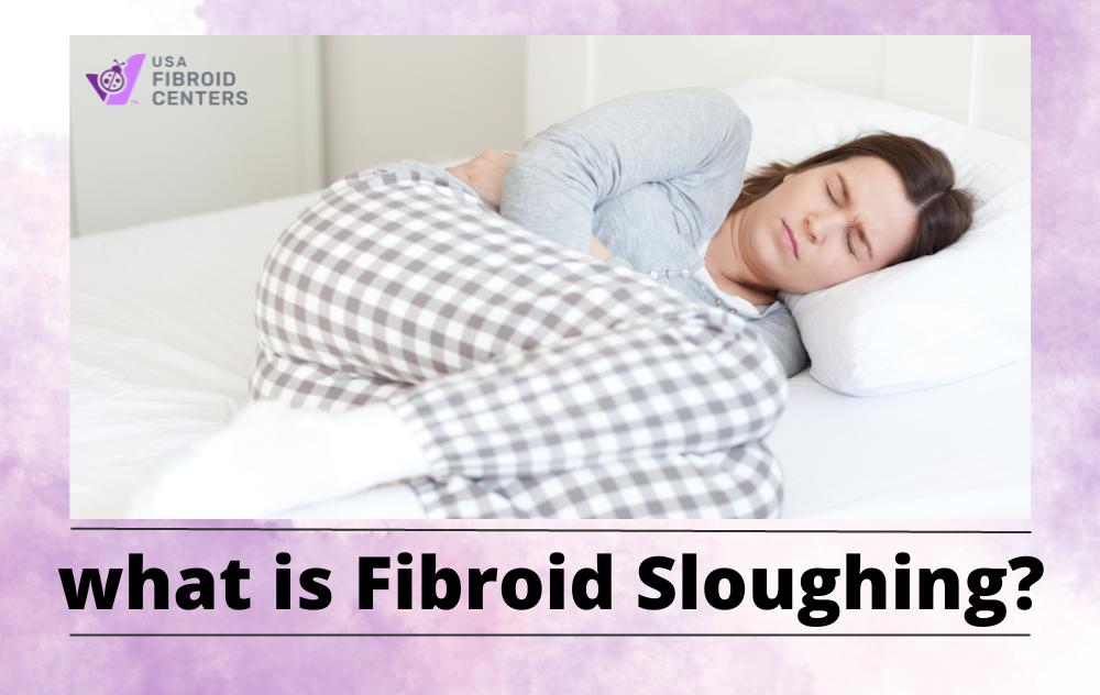 What Is Fibroid Sloughing?