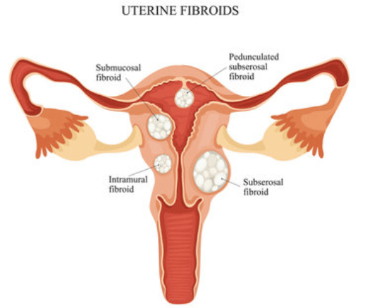 Types of Other Fibroids