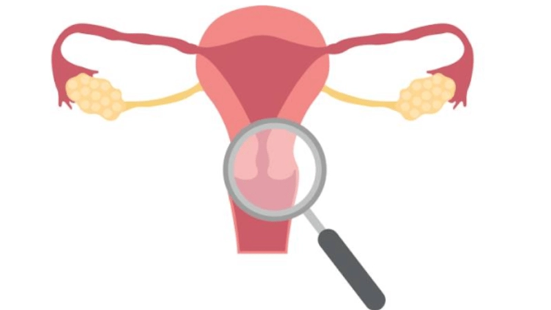 What Are Intramural Fibroids