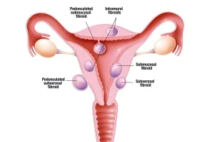 types-of-fibroids-diagram.jpg