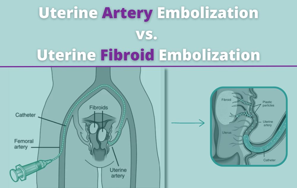 Uterine Artery Embolization vs. Uterine Fibroid Embolization