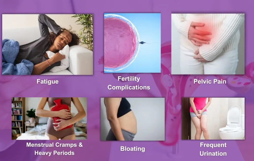 Uterine Fibroid Uterus Size Chart