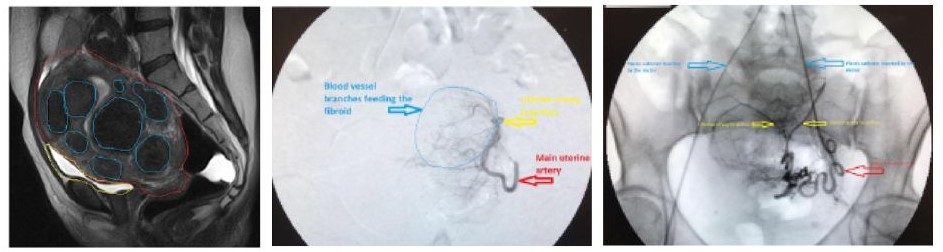 Fibroids Shrink After UFE Procedure