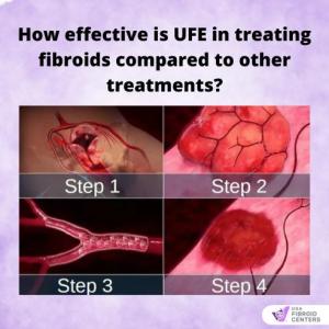 UFE Steps to shrink fibroids