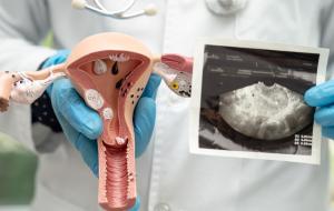 what happens to a fibroid during a uterine fibroid embolization procedure 
