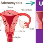 Can you treat Adenomyosis with UFE?