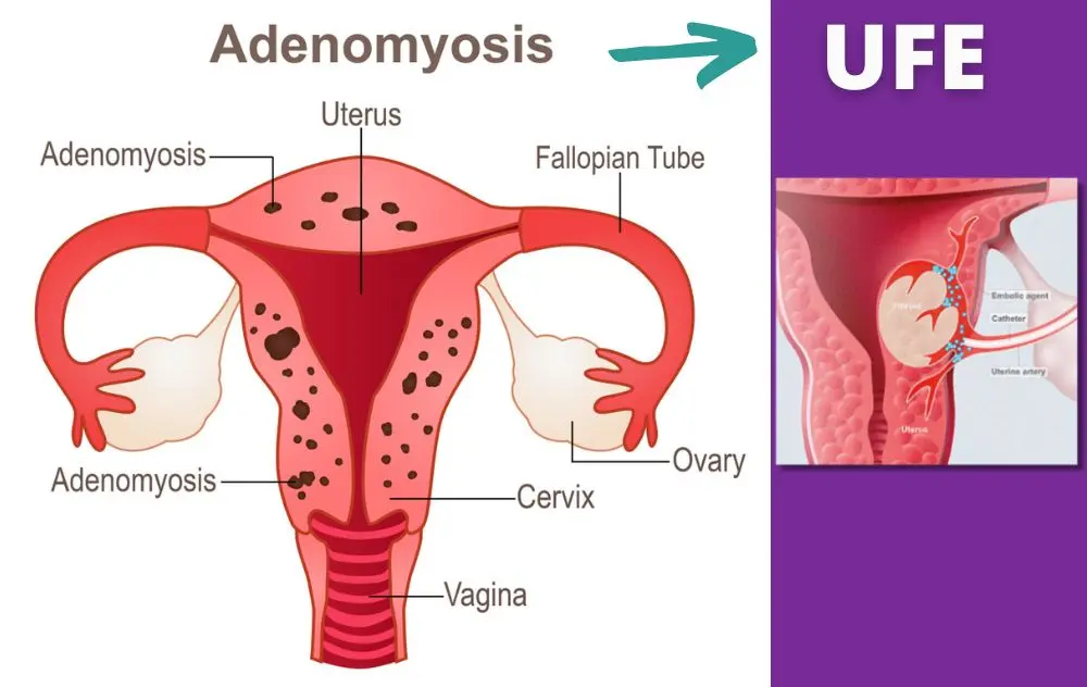 Can you treat Adenomyosis with UFE?