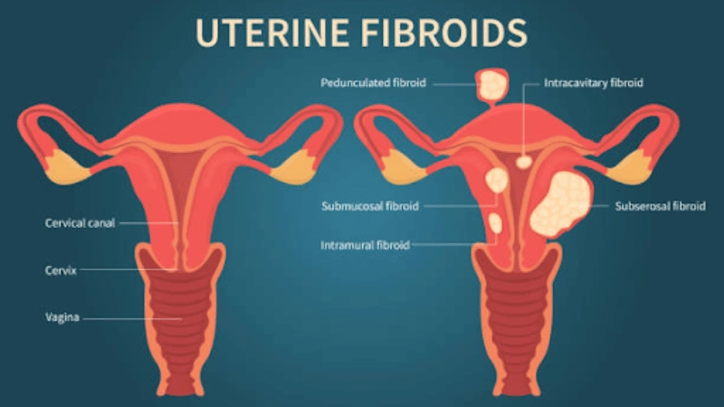 Signs Of Fibroids Breaking Down | USA Fibroid Centers