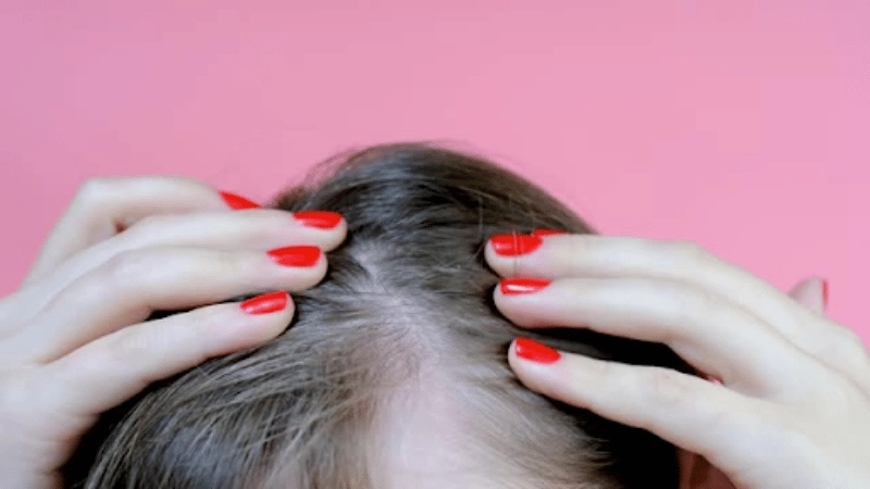 Can Fibroids Cause Hair Loss? 1 Can Fibroids Cause Hair Loss?