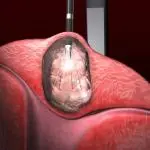 Fibroid Picture