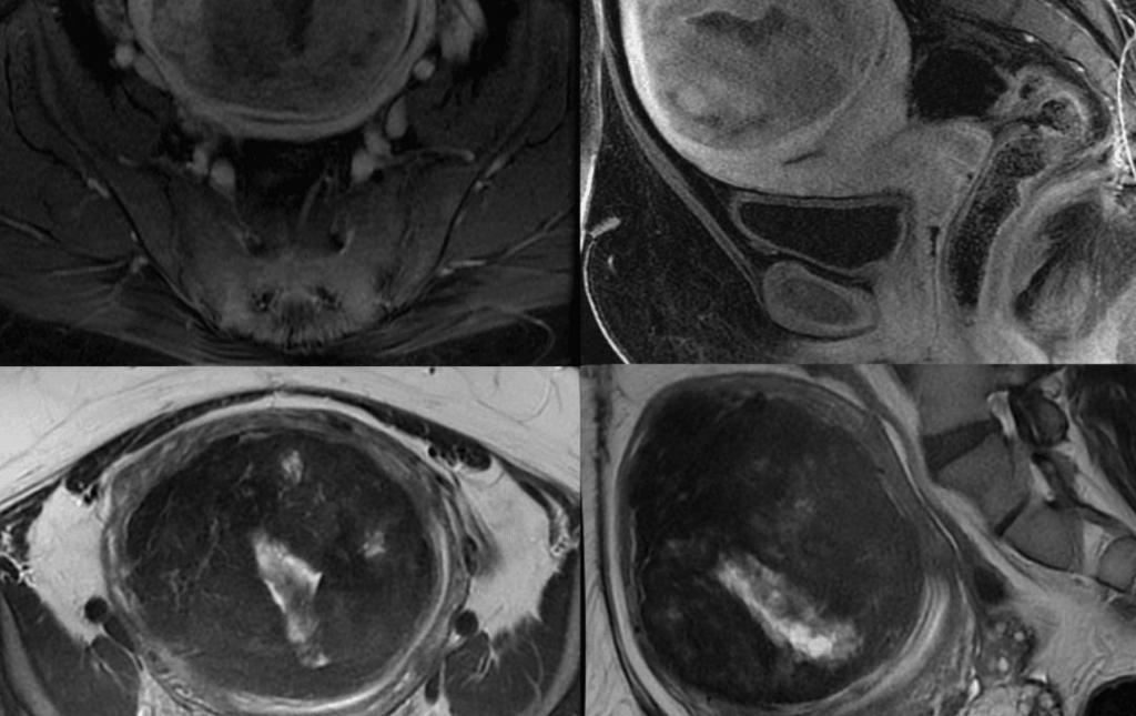 Pictures Of Fibroids 8 Pictures of Fibroids in MRI