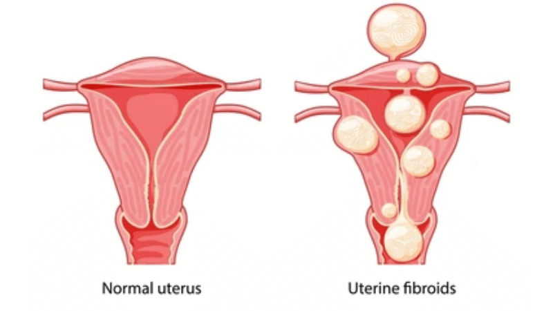 How Can Uterine Fibroids Cause Back Pain