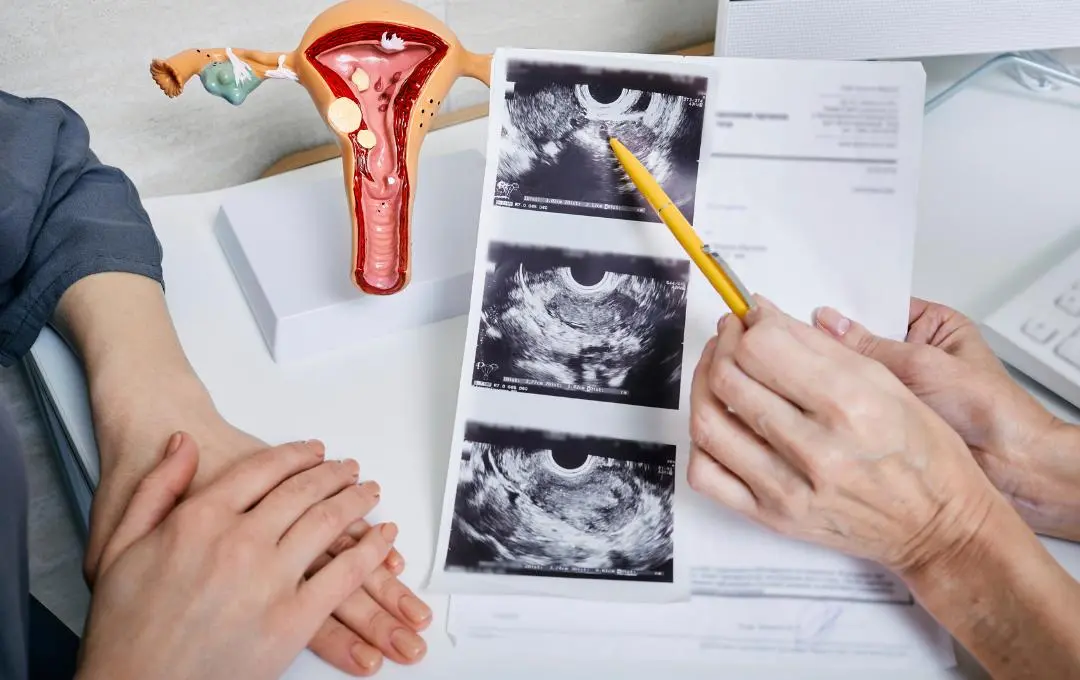 What To Know About Pcos And Fibroids 1 PCOS Awareness 1080 x 680 px 3