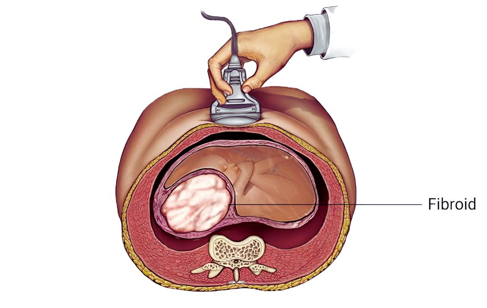 fibroids-and-pregnancy-usa-fibroid-centers