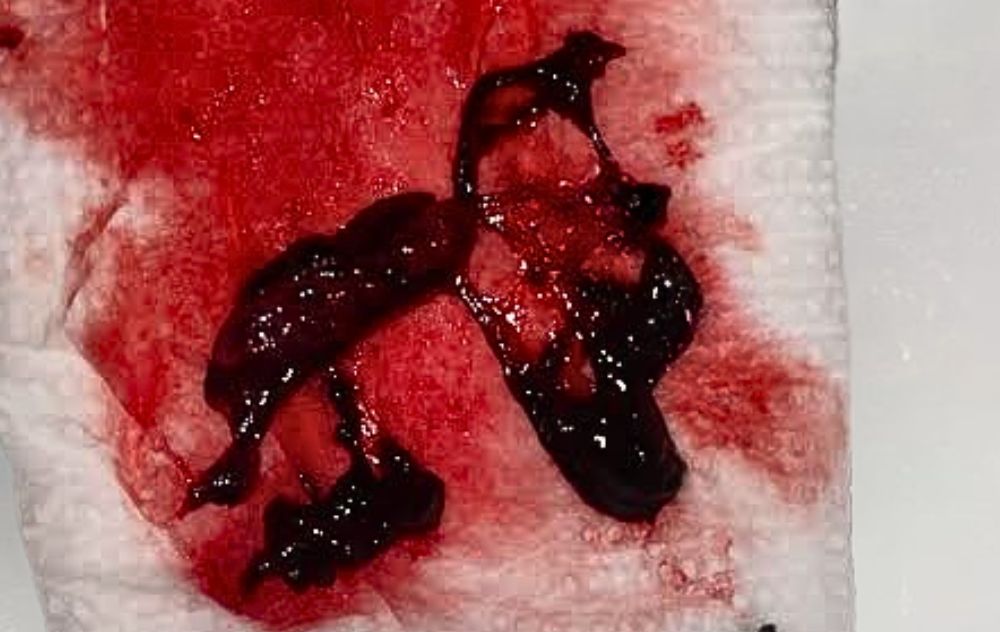What Is Fibroid Sloughing? 3 What Fibroid Sloughing Looks Like