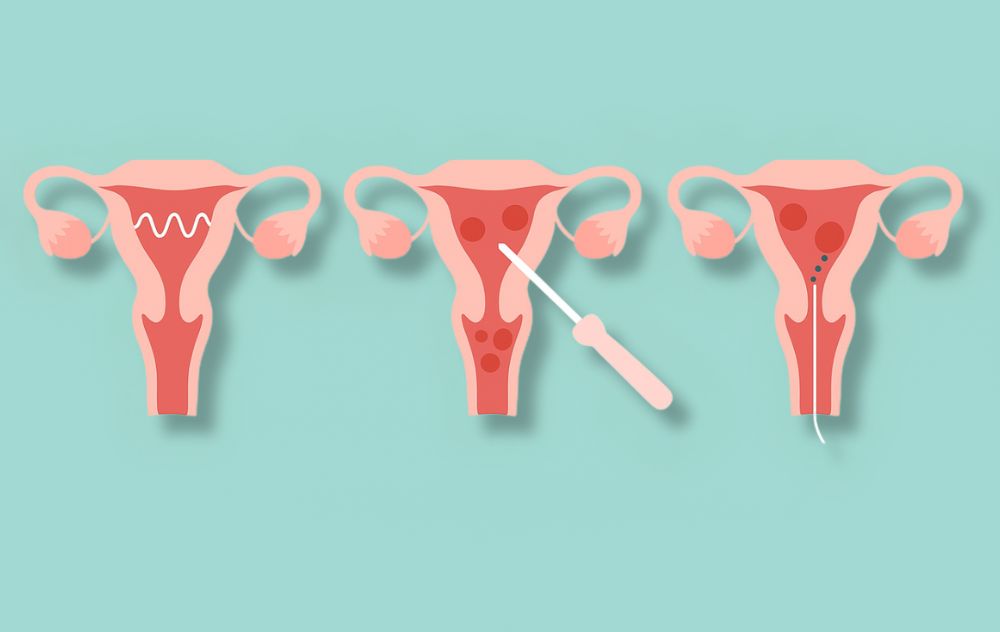 Is Endometrial Ablation The Same As Uterine Fibroid Ablation? 1 Is Endometrial Ablation the Same as Uterine Fibroid Ablation