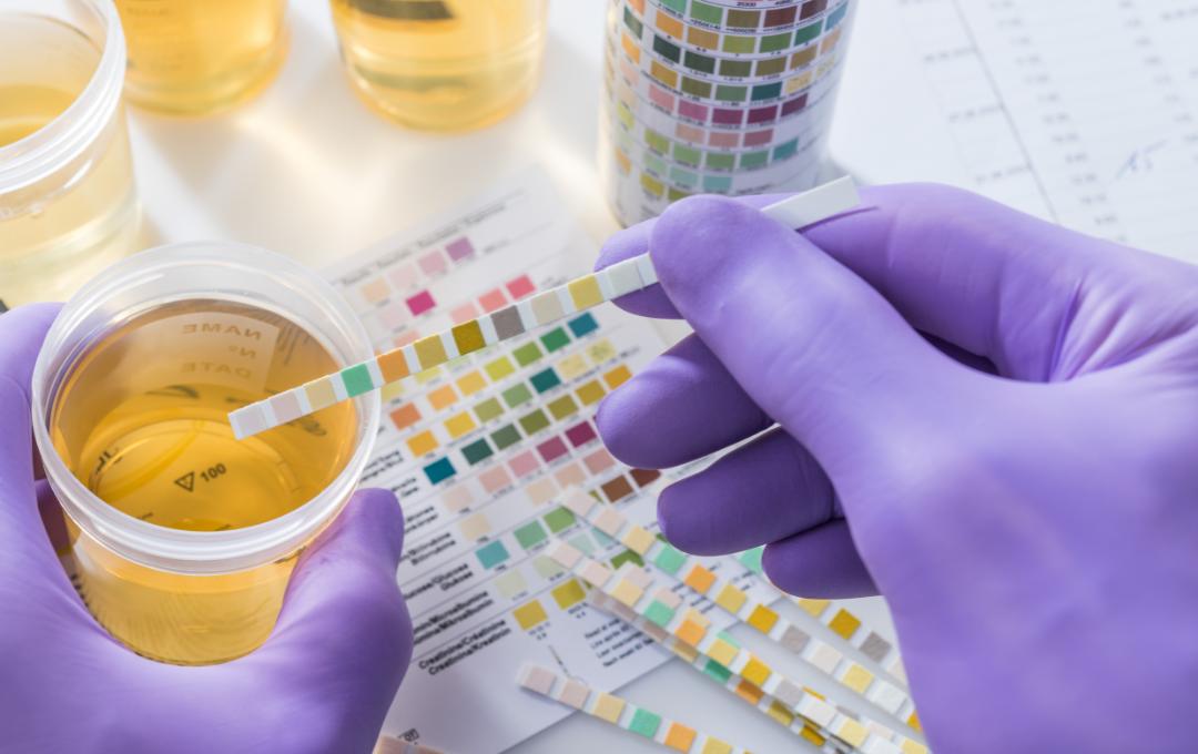 Causes Of Urinary Urgency In Females 2 Urine sample being tested to check for infections.