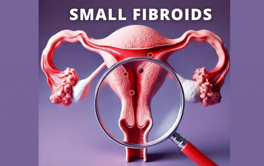 Do Small Uterine Fibroids Still Need Treatment? 1 Do Small Uterine Fibroids Still Need Treatment?