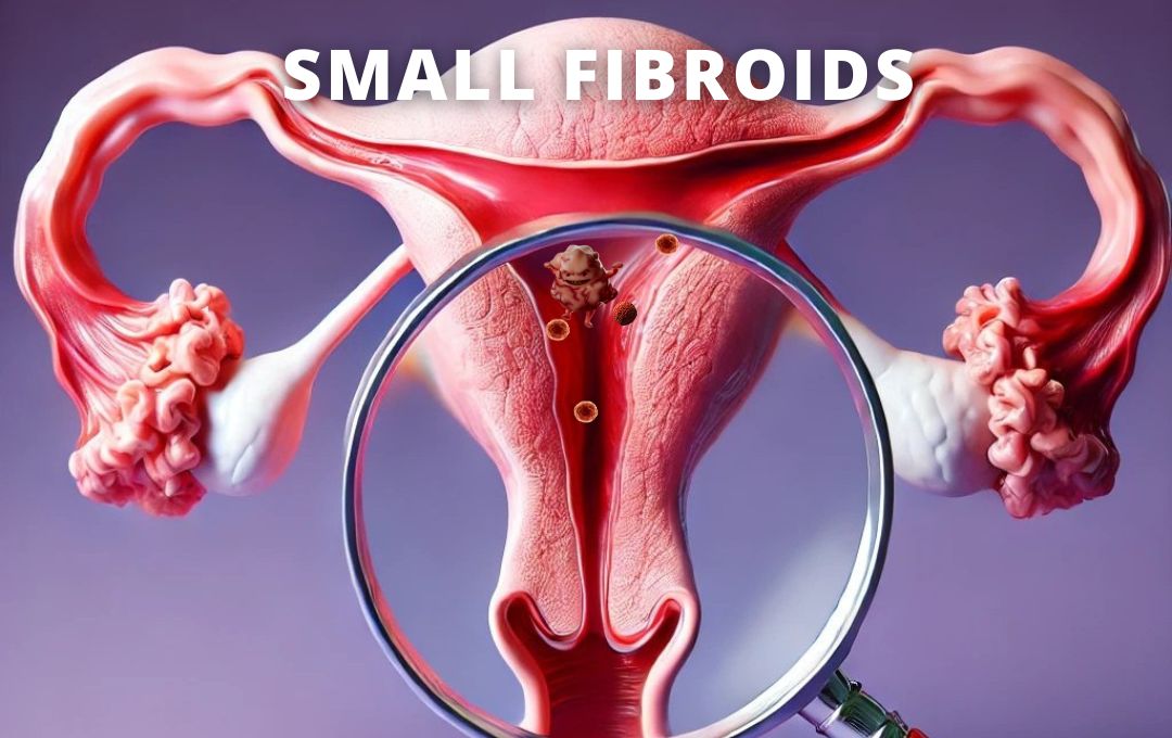 Do Small Uterine Fibroids Still Need Treatment?