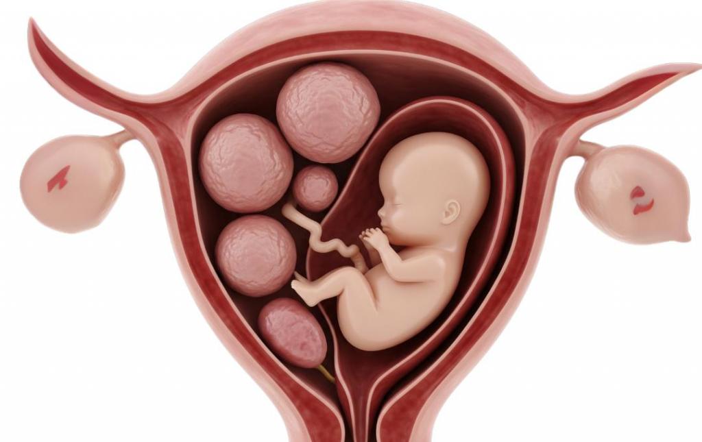 Fibroids during pregnancy