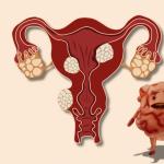 Do Fibroids Go Away on Their Own