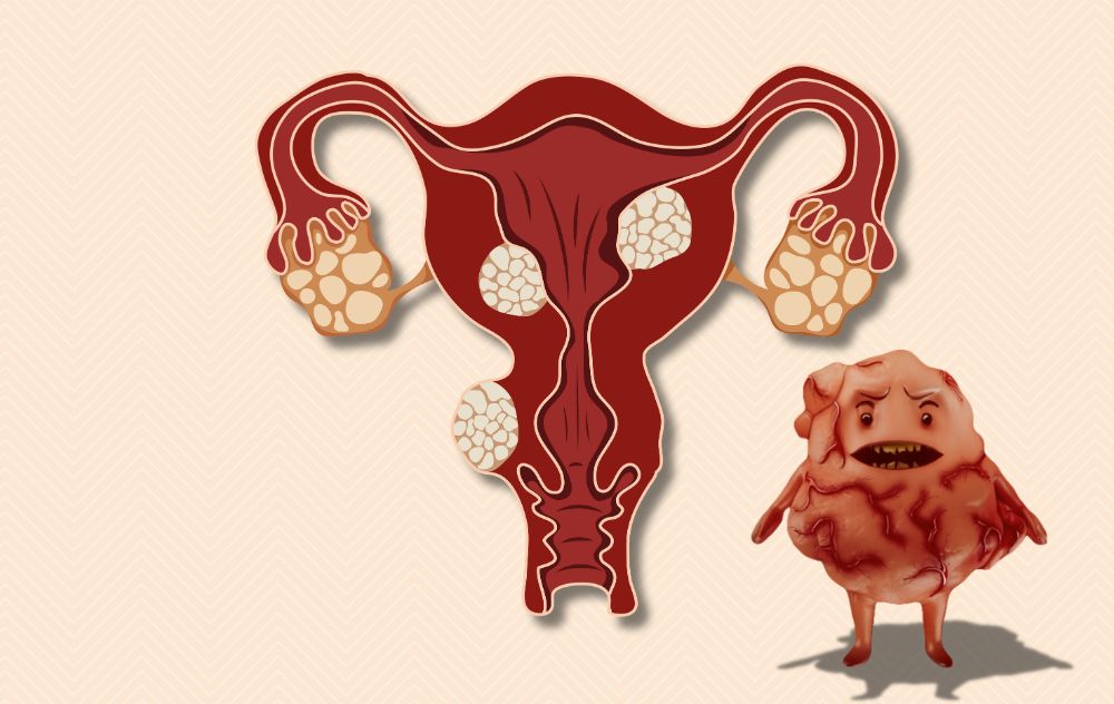 Do Fibroids Go Away on Their Own