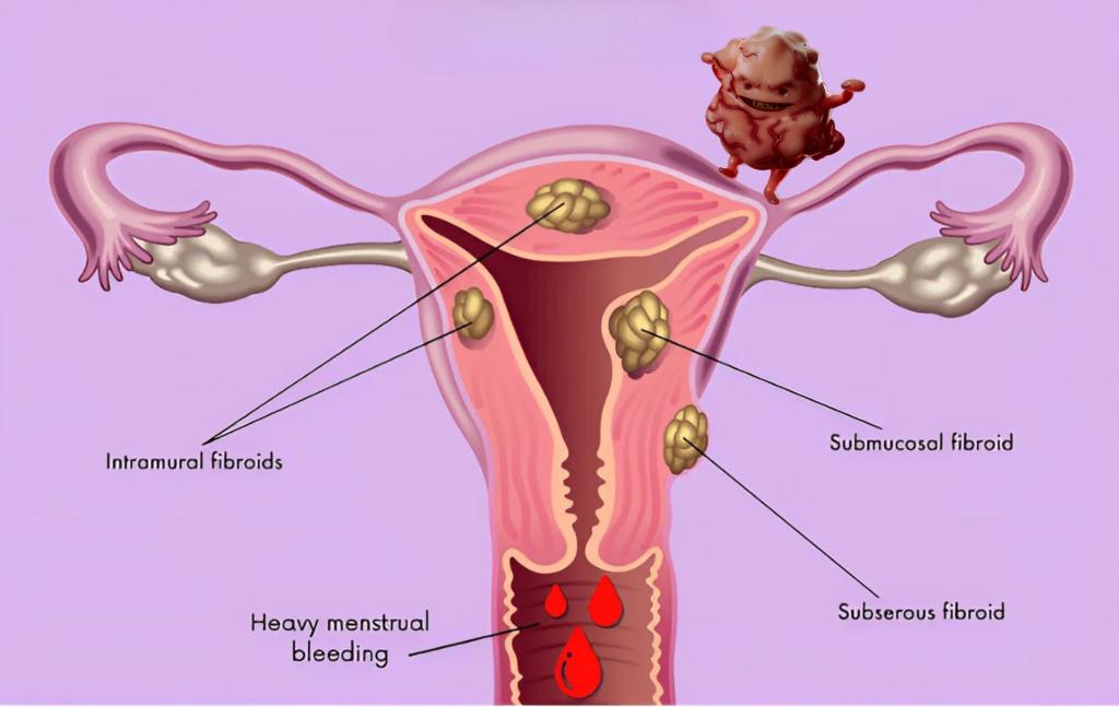 Examples of how fibroids cause bleeding