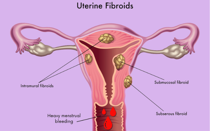 How Fibroids Cause Heavy Menstrual Bleeding
