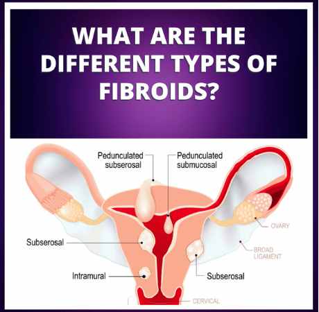 Understanding Fibroids: Why a Self-Exam Isn't Possible