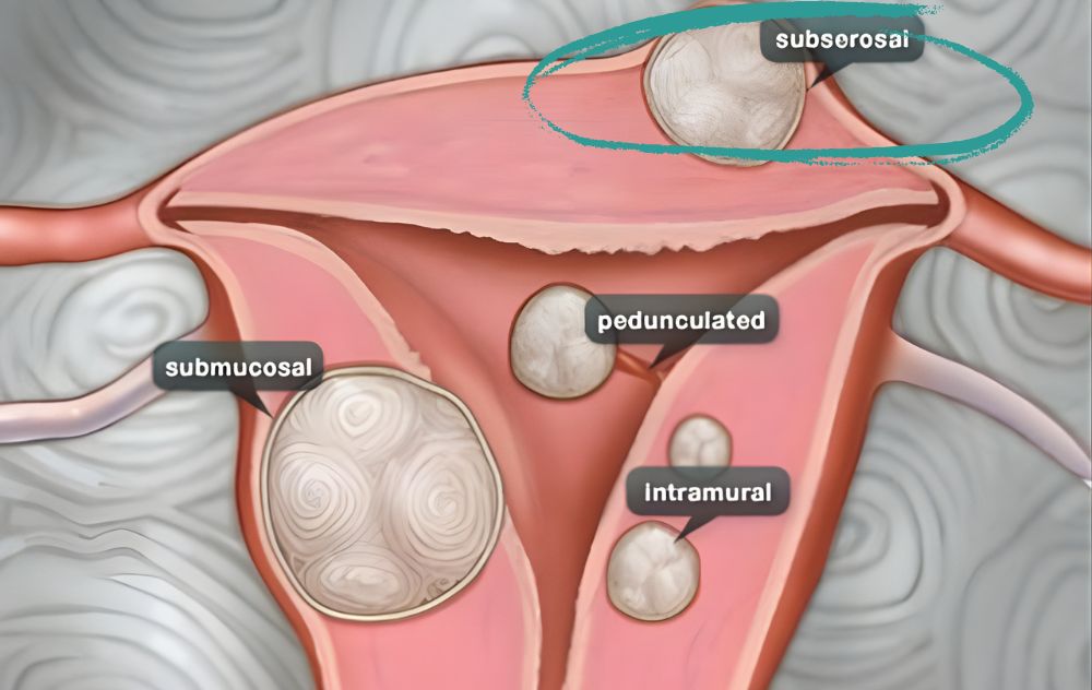 Showing where Subserosal Fibroids are located and if they Need to Be Remove