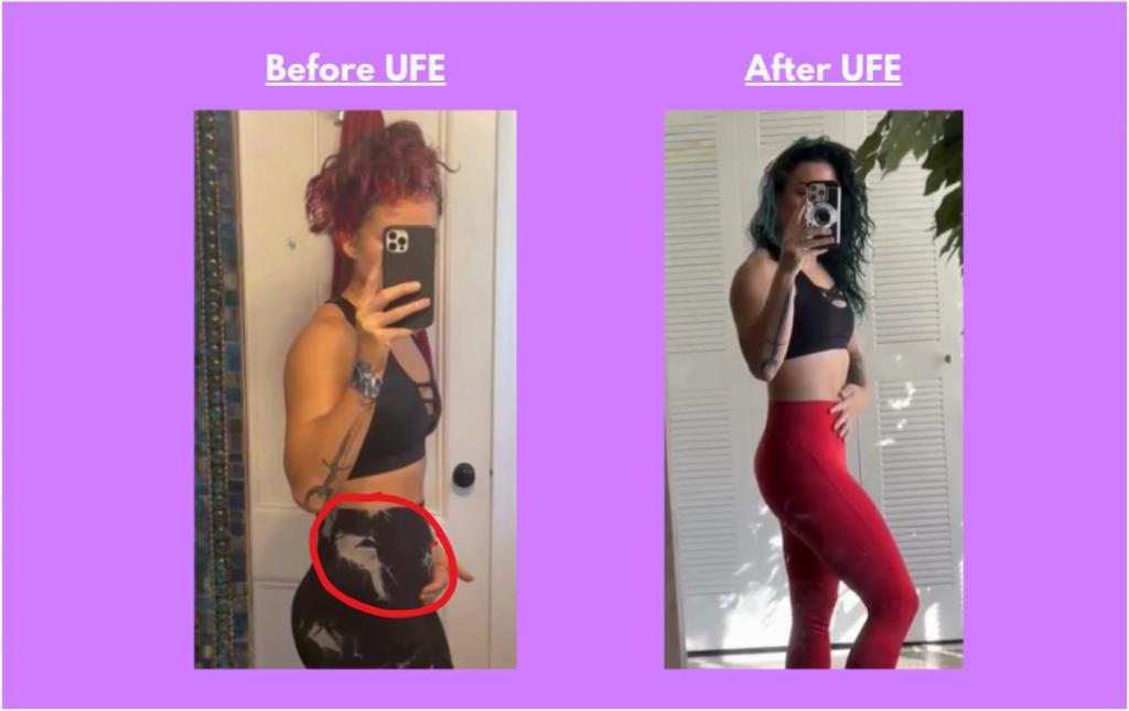 Transformations: Fibroid Belly Before And After 2 Cara Nara Fibroid body. resized