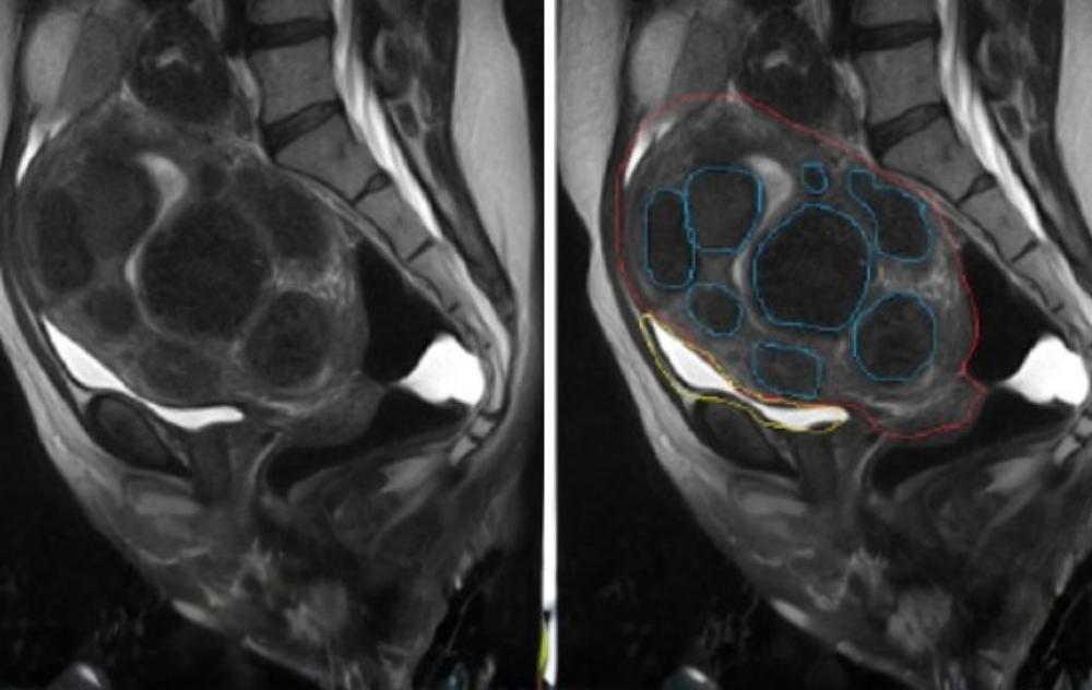 Transformations: Fibroid Belly Before And After 4 Fibroid MRI 1