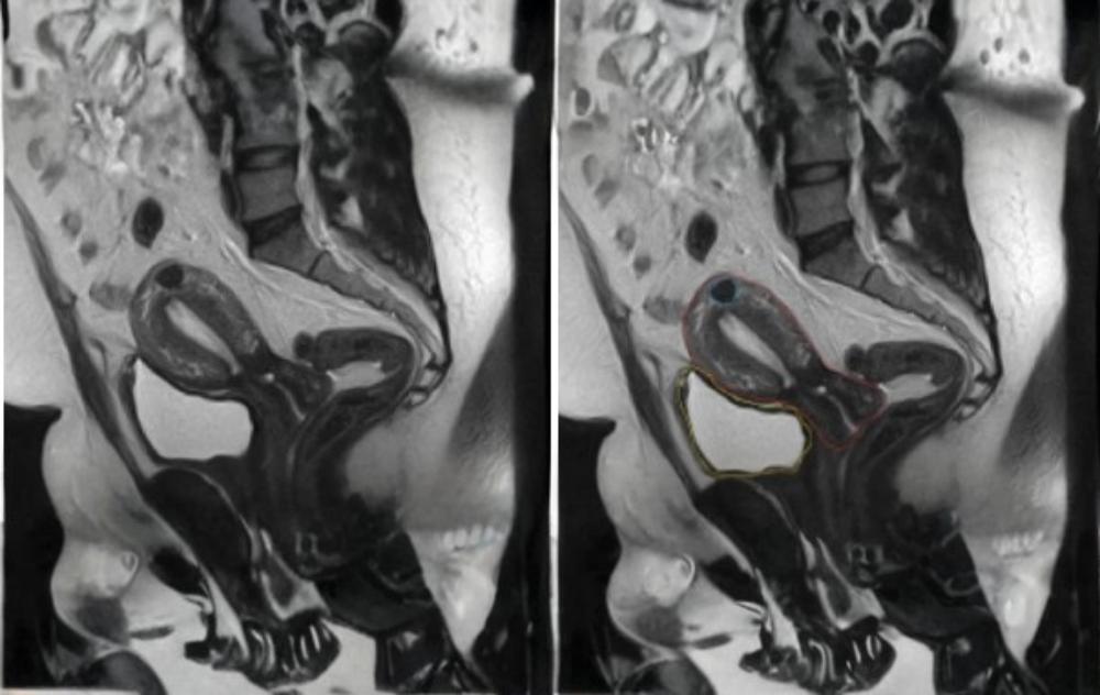 Transformations: Fibroid Belly Before And After 3 Fibroid MRI Imaging