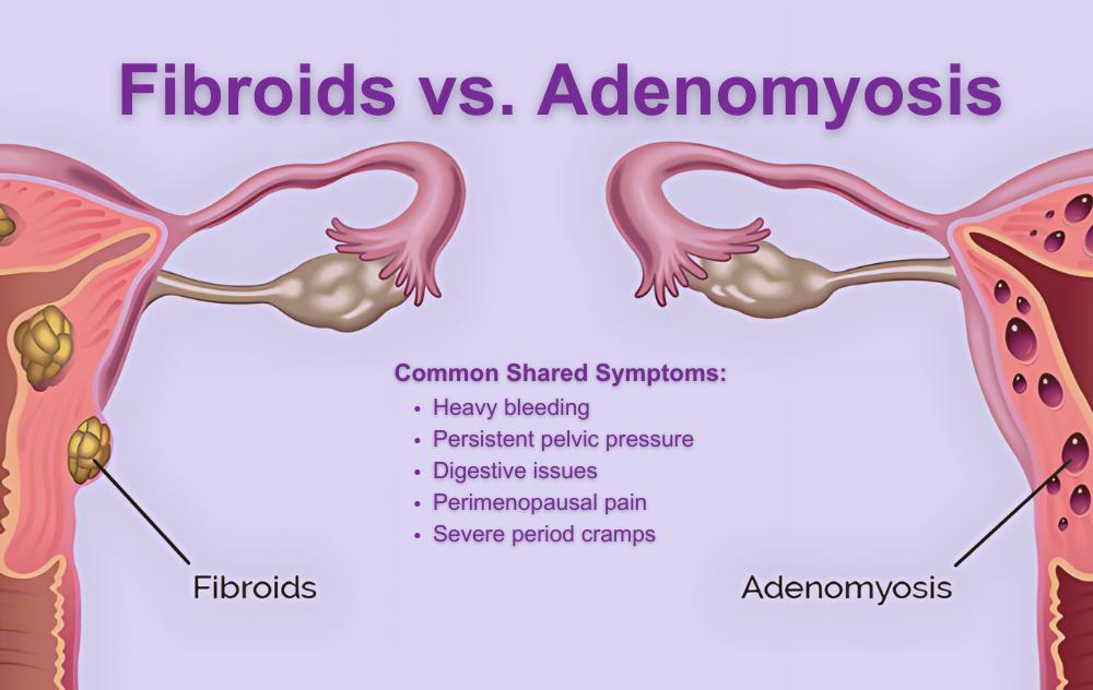 Can Adenomyosis Be Treated Without Surgery? 2 Fibroids vs. Adenomyosis
