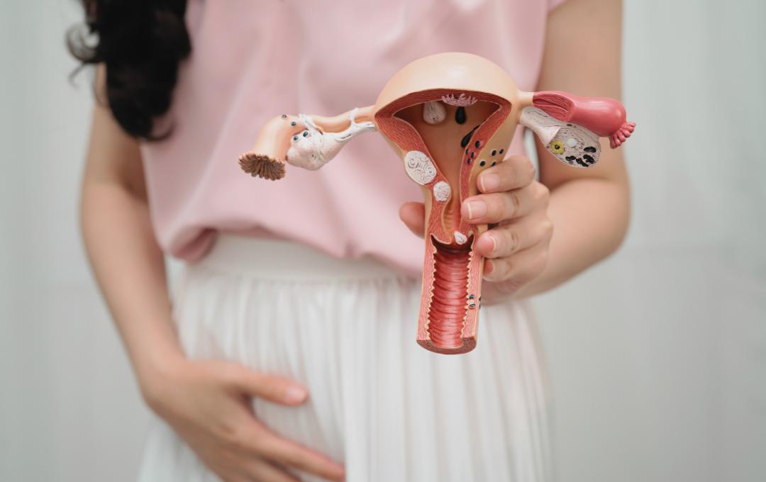 Fibroid Vs. Polyps: What’s The Difference? 4 A woman holding a model vagina showing polyps and fibroids present together.