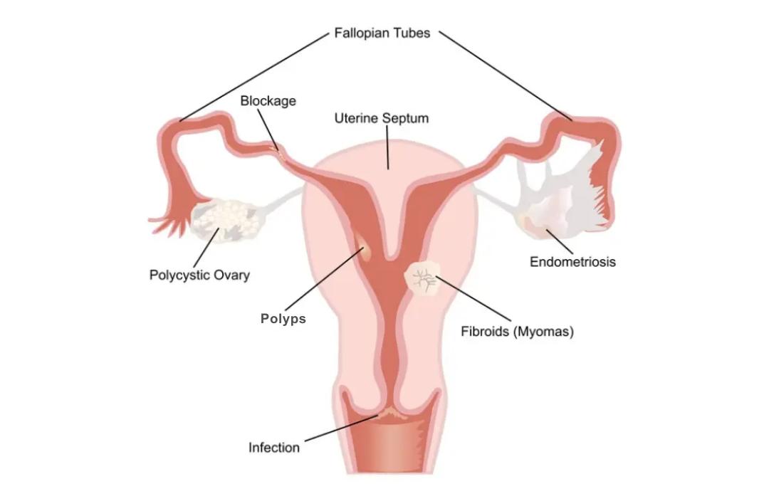 Fibroid Vs. Polyps: What’s The Difference? 3 The graphic shows the locations of fibroids, polyps, ovarian cysts and endometriosis in the uterus.