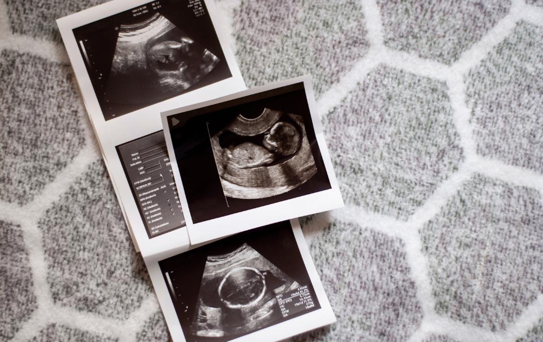 Can Fibroids Cause Miscarriages? 4 Three sonograms showing the different stages of fetus growth in the three pregnancy trimesters.