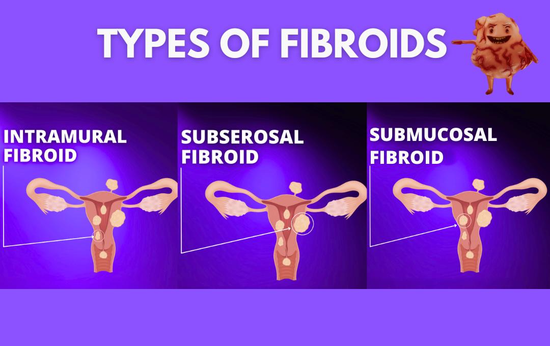 Can Fibroids Cause Miscarriages? 2 The three types of fibroids
