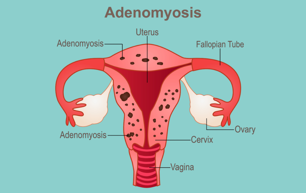 Does Adenomyosis Have Stages? What Specialists Actually Look For 2 Diagram of the uterus with adenomyosis