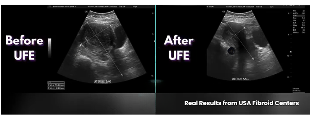 Pictures Of Fibroids 13 Fibroid Ultrasound of uterus showing before and after UFE