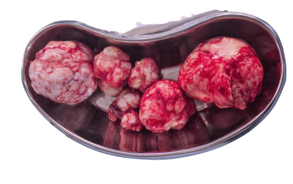 Pictures Of Fibroids 10 Fibroids after being removed