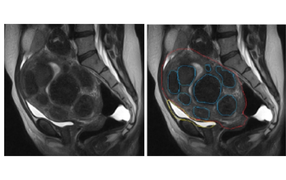 Pictures Of Fibroids 7 Fibroids in uterus on MRI