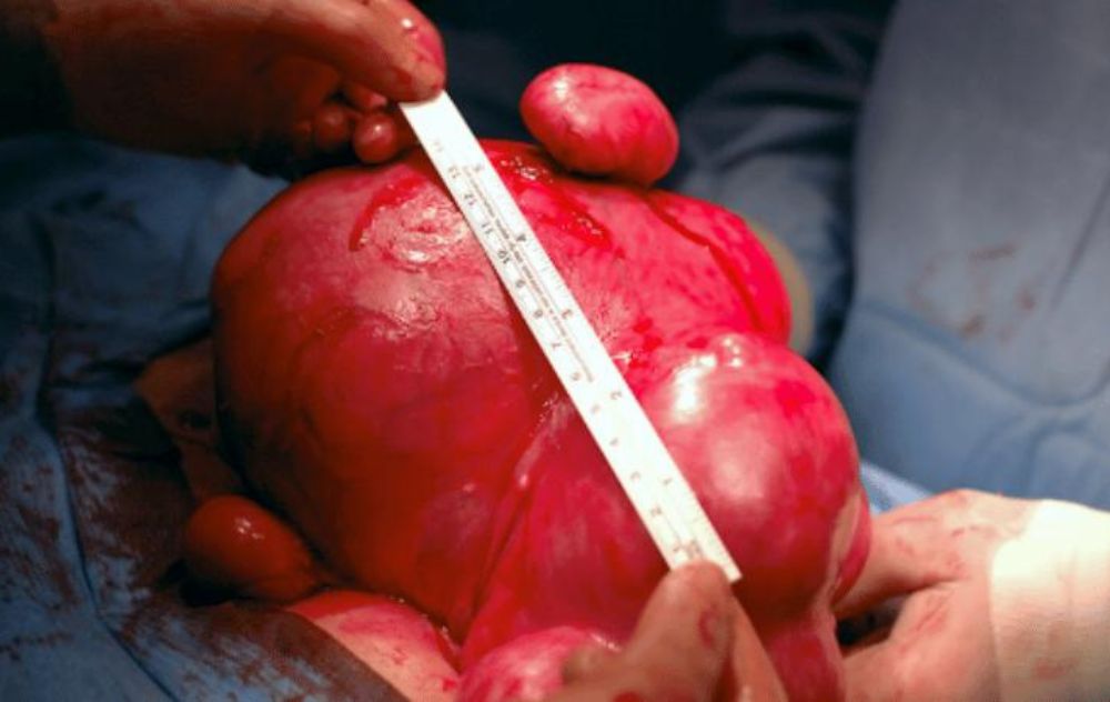 Pictures Of Fibroids 11 Large Fibroids in Uterus