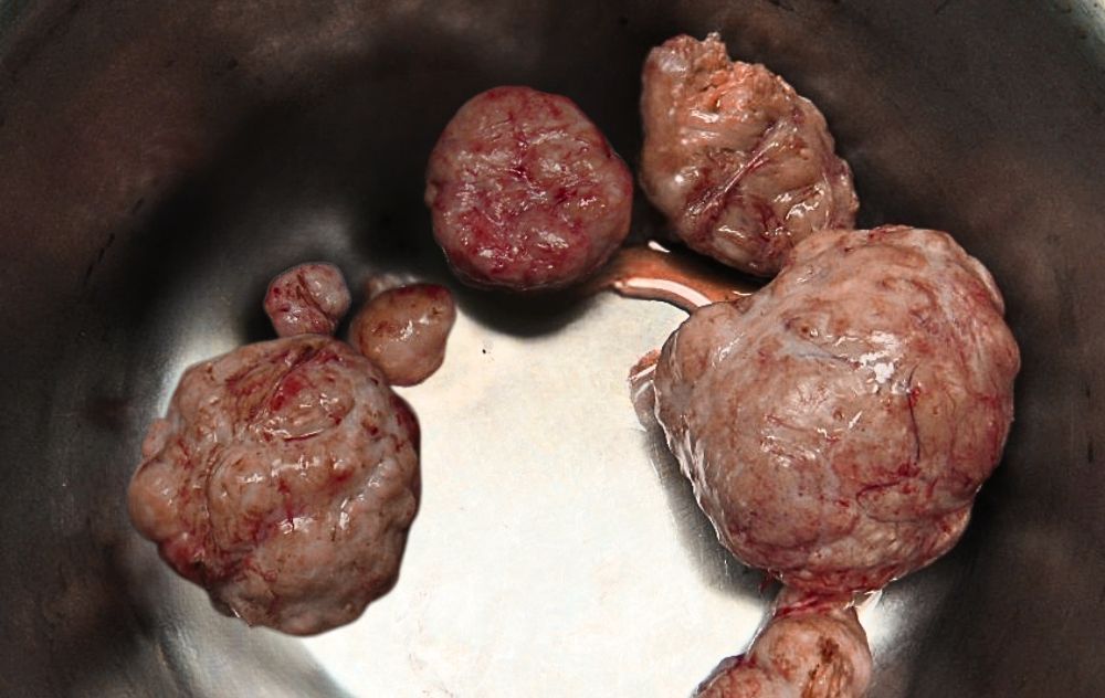 Pictures Of Fibroids 3 Real uterine fibroids removed from the uterus