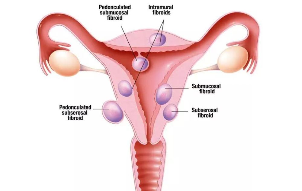 Do Fibroids Cause A Burning Sensation? 2 Types of Fibroids in the Uterus